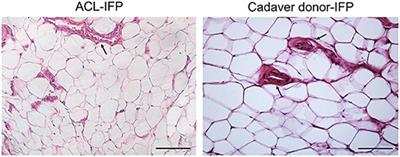 Age-Dependent Remodeling in Infrapatellar Fat Pad Adipocytes and Extracellular Matrix: A Comparative Study